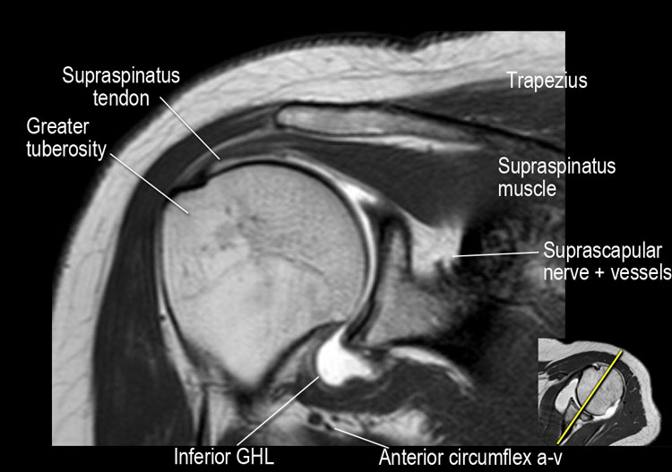 mri shoulder